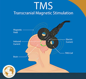 TMS Therapy Near Me in Creve Coeur, MO