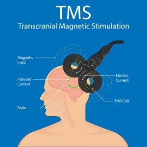TMS Therapy Near Me in Independence, MO 